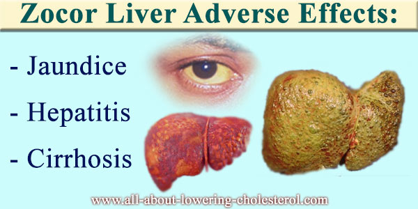 zocor-liver-adverse-effects-all-about-lowering-cholesterol